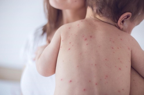 Tuyên truyền về phòng, chống bệnh thủy đậu